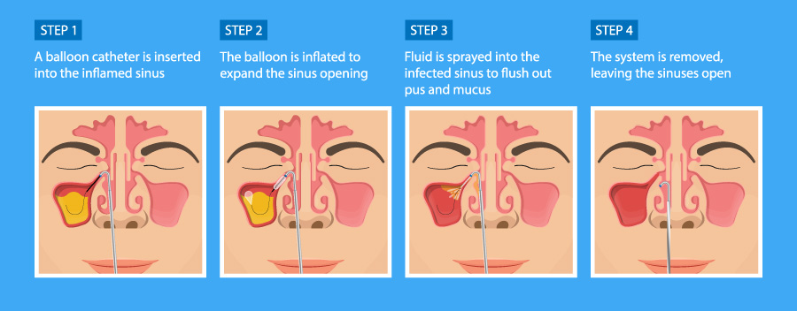 Balloon Sinuplasty patient education